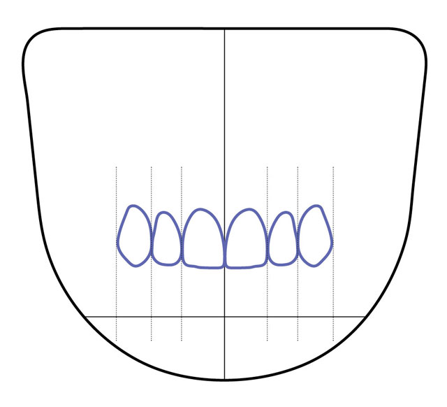 Figure 20 - Printed Custom Template to be used for diagnostic wax-up/